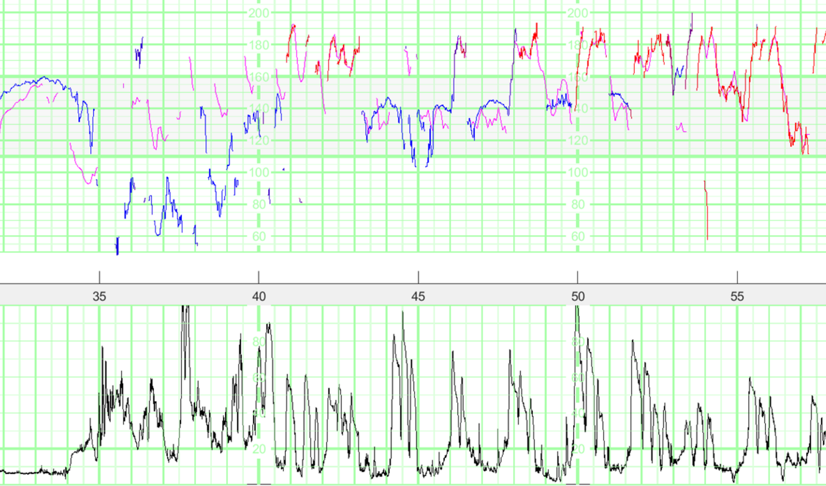 Fetal Heart Rate Tracings Associated With Eclamptic, 58% OFF